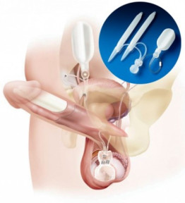 Penile Prosthesis