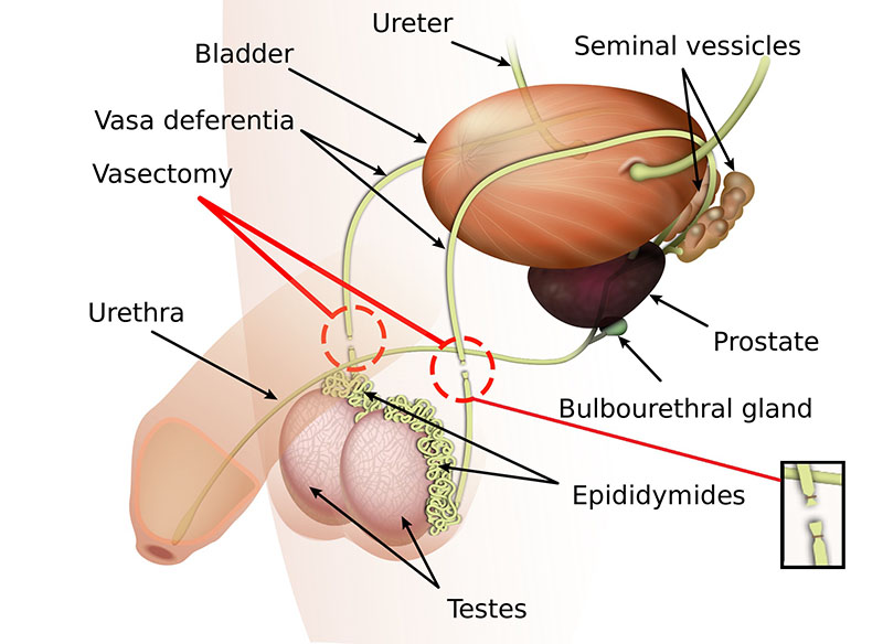 Reversal Vasectomy Genital Surgery