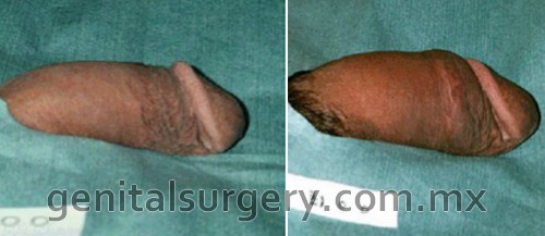 Enlargement Penis