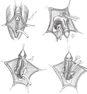 Metoidoplasty Sex Surgery